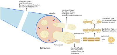 Electrical stimulation therapy for peripheral nerve injury